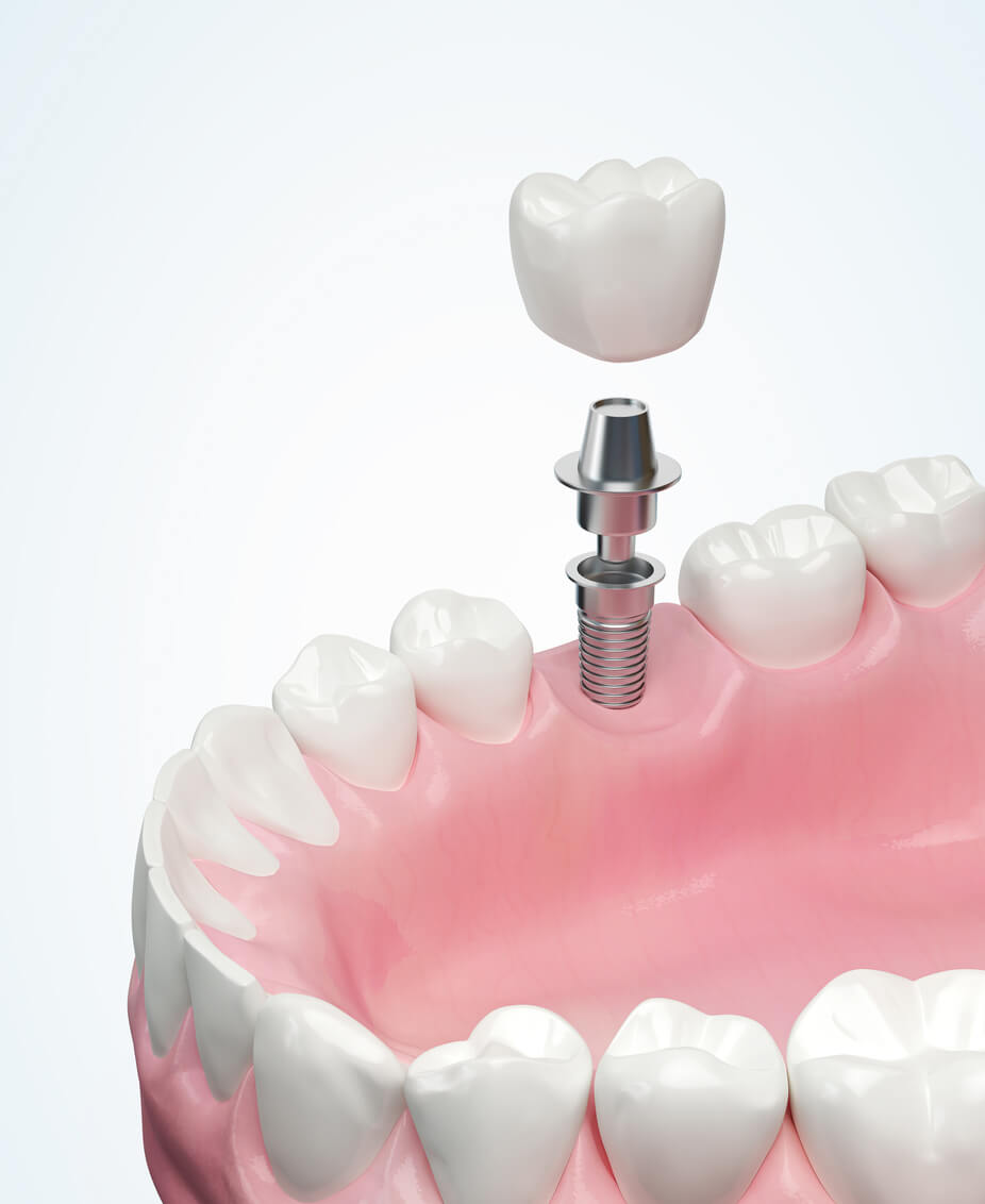 Single dental implant procedure at Fusion Dental Implants Roseville